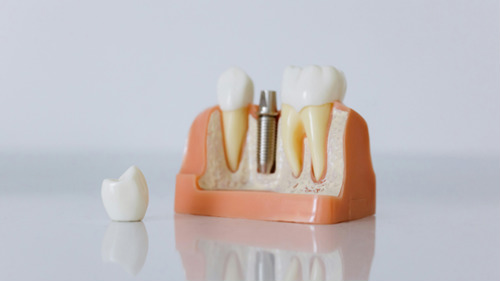 Dental implant model showing the implant post abutment and crown placed in the jawbone at Finer Smil